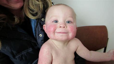 10 Month Old Boy With Red Macular Spreading Rash The Doctors