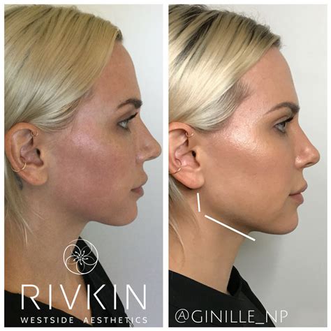 Non Surgical Jawline Enhancement By Ginillenp Its Becoming