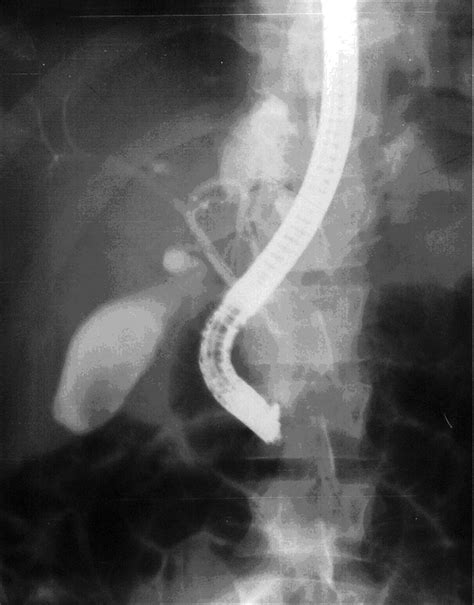 Ercp Showing A Biliary Leak In The Area Of The Left Hepatic Duct A