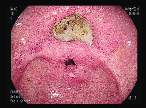Endoscopic View Of The Gastric Antrum Of Case Showing A Large Deep