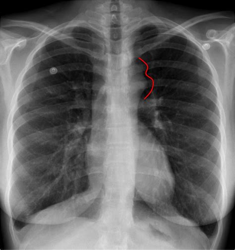 Figure 3 Sign A Chest Radiograph Sign Of Aortic Coarctation Where The