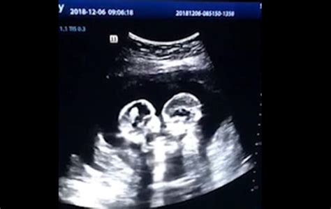Watch Identical Twin Babies Shown On Ultrasound Fighting In The Womb Hot Sex Picture