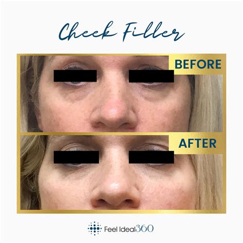 Facial Filler Before And After Feel Ideal Med Spa Southlake Tx