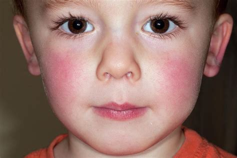 Slapped Cheek Disease Photograph By Dr P Marazzi Science Photo Library