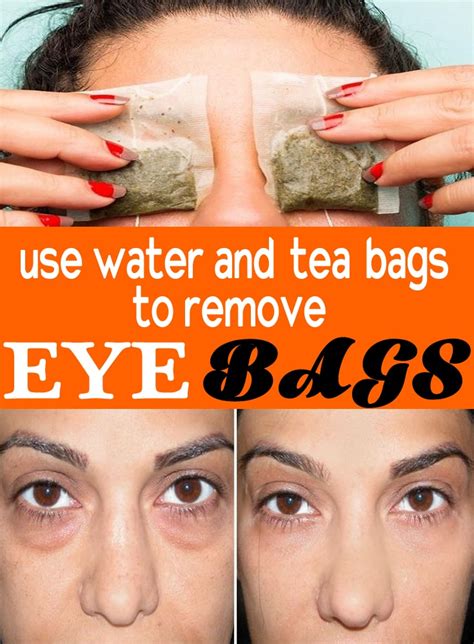 You could have festoons or malar mounds. How To Get Rid Of Bags Under Eyes Fast Best Home Remedies ...