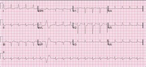 Which Patient Should Get Acute Cath Lab Activation In Mi