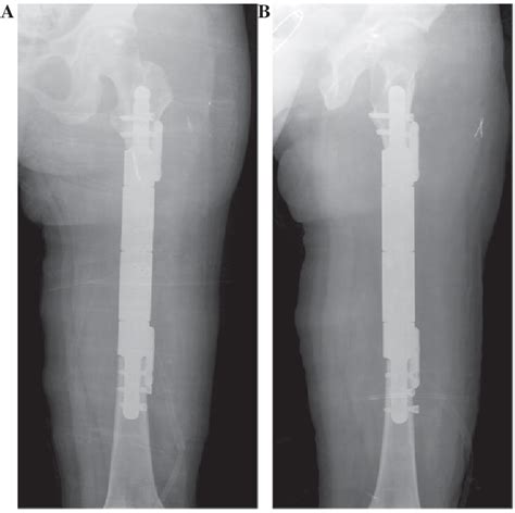 Figure From Custom Made Intercalary Endoprosthetic Reconstruction For