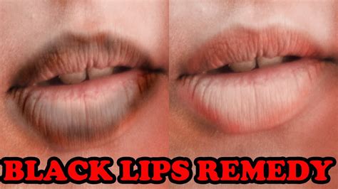 Get Rid Of Black Lips From Smoking Lip Lightening Home Remedies For