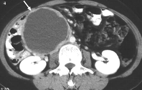 Retroperitoneal Cystic Masses Ct Clinical And Pathologic Findings