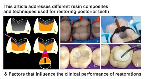 Dentistry Journal Free Full Text Resin Composites In Posterior