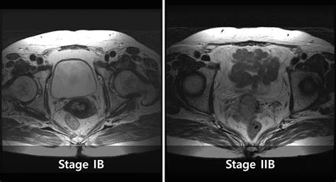 Cervix Cancer Staging Figo With Mri Photos Q Radiology