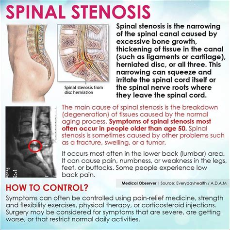 Here Are Some Basic Facts About Spinal Stenosis Cervical Spinal