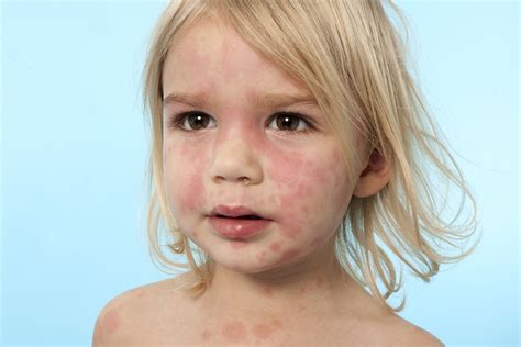 Allergy Trigger Red Rash Around Mouth And Eyes Child