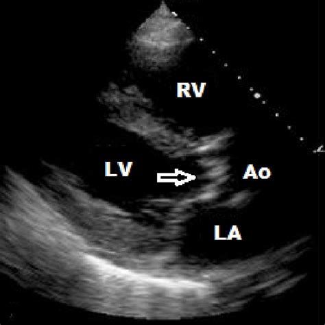 Cureus An Unusual Case Of Aortic Stenosis In Systemic Sclerosis