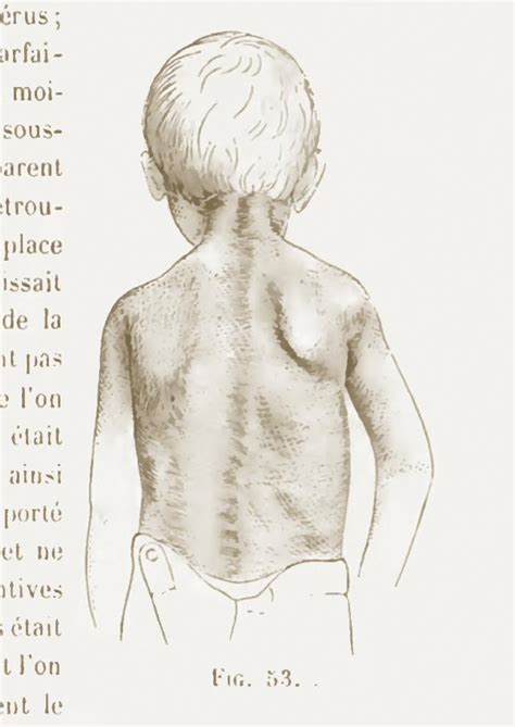 Pdf Obstetric Brachial Plexus Palsy A Framework For Therapy