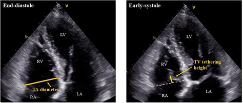 Frontiers Incidence Of Atrial Functional Tricuspid Regurgitation And