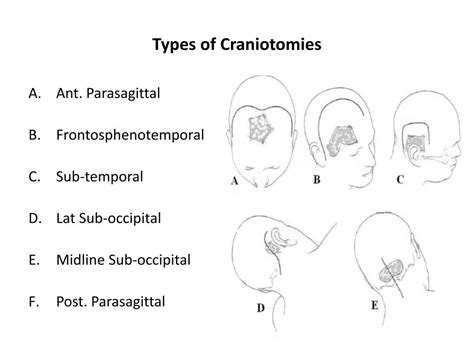 Ppt Patient Positioning In Neuroanaesthesia Powerpoint Presentation