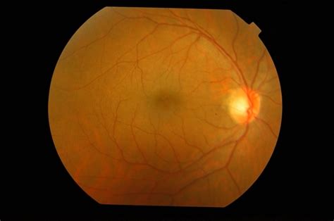 When the retinal tissue tears or detaches completely, causing blurred vision or blindness. Large Traumatic Retinal Tear - Retina Image Bank