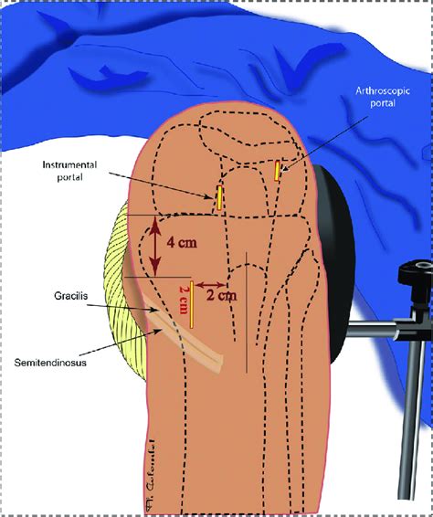 Skin Incisions This Surgery Requires 3 Incisions One 2 Cm Length