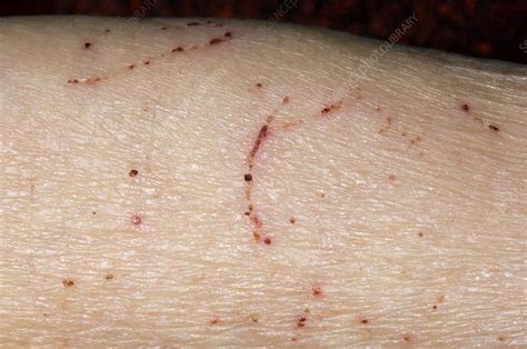 Scabies On Arm Stock Image M2600378 Science Photo Library