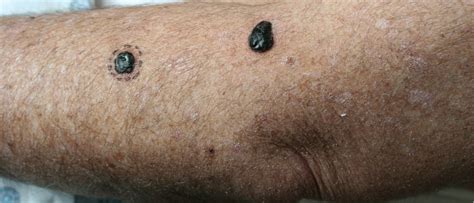 Hemorrhagic Bullae In A 73 Year Old Man Cardiology Jama Dermatology