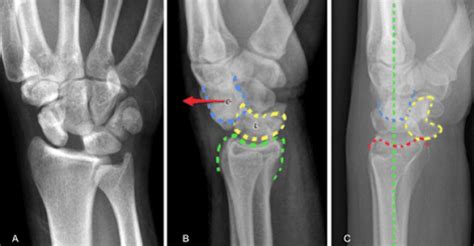 Splinter Series A Case Of Traumatic Wrist Pain After Fall On