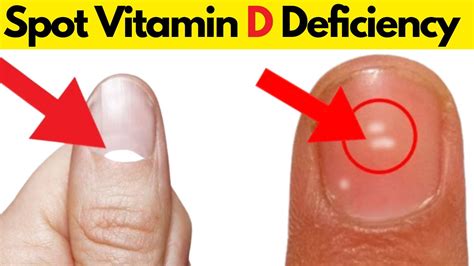 5 Signs And Symptoms Of Vitamin D Deficiency YouTube