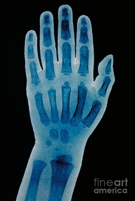 Hand X Ray Of A 2 Year Old Child Photograph By Scott Camazine And Sue Trainor