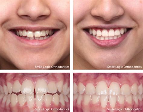 Braces Before And After Smile
