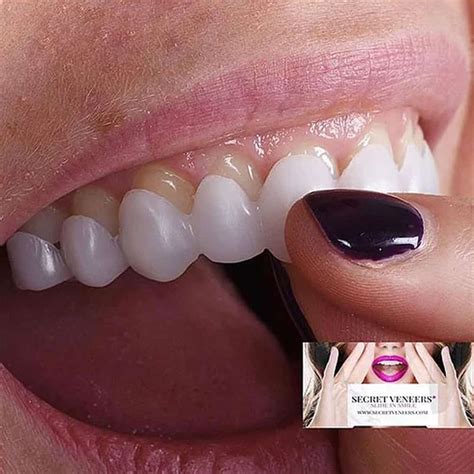 Do It Yourself Veneers What You Need To Know About Diy Veneers You Have To Imitate The