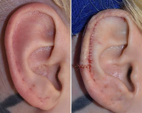 Blog Archiveor Snapshots Vertical Ear Reduction With Scaphal