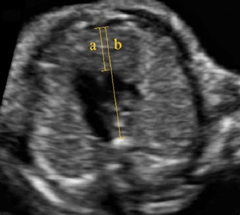 Three Vessel View Showing The Anteroposterior Diameter Of The Fetal