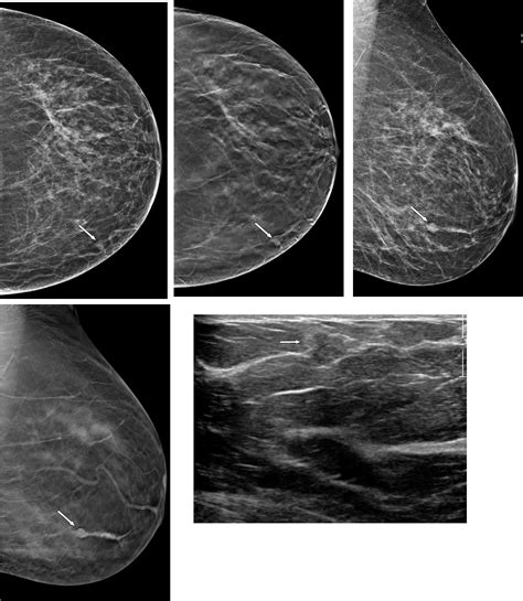 Overlap Of Breast Tissue Architectual Distortion Overlapping Breast