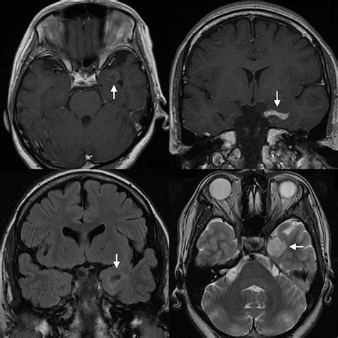 Surgery For Amygdala Enlargement With Mesial Temporal Lobe Epilepsy