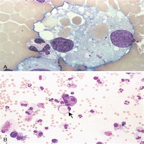 Body Fluid Analysis In The Hematology Laboratory Rodaks Hematology