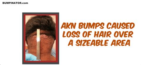 Video I Terminated My Akn Back Of Head Bumps Results