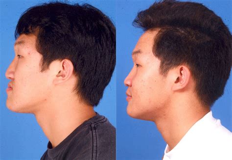Jaw Surgery Before And Afters James P Bradley Md