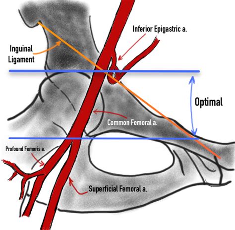 The Anatomy Of Femoral Vascular Access — Taming The Sru