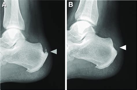 Preoperative And Postoperative Radiographs Of The Left Calcaneus Of The