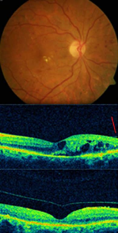 Complete Posterior Vitreous Detachment And Complete Resolution Of