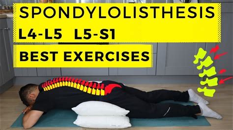 Anterolisthesis L5 S1 Treatment Spondylolisthesis L4 L5 Lumbar Spine