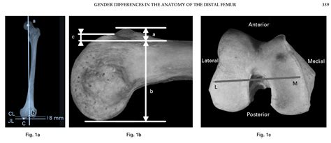 Knee Research Gender Differences In The Anatomy Of The Distal Femur Cleveland Shoulder Elbow