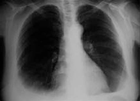 Posteroanterior Chest X Ray Demonstrates Bilateral Pleural Effusions