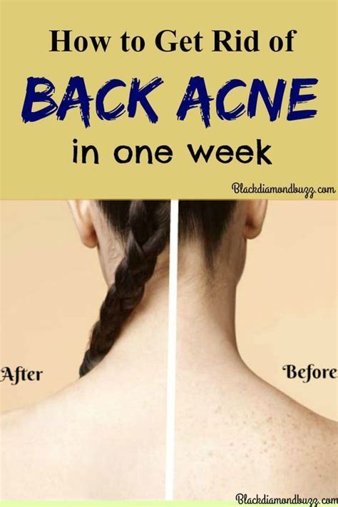 Back Acne Remedies How To Get Rid Of Acne On Back Fast At Home