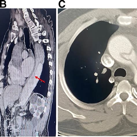 Ct Angiography Of The Abdominal And Thoracic Aorta Showing A Type A