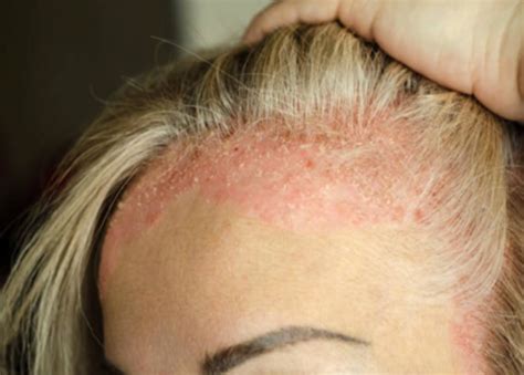 Itchy Scalp Causes And How To Treat It Be Beautiful India