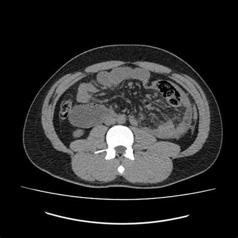 Left Paraduodenal Hernia Image