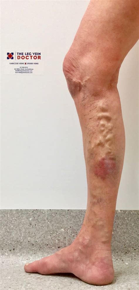 Varicose Vein Surgery Not Done In The Usa In 2018 — The Leg Vein