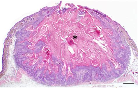 Keratoacanthoma Histology