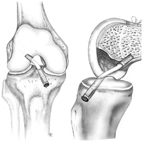 Non Anatomical Double Bundle Hamstrings Autograft Acl Reconstruction Download Scientific